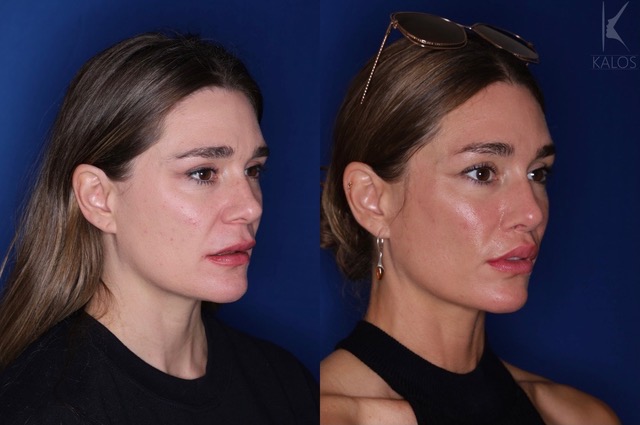 Interview Elite Atlanta Facial Plastic Surgeon Ben Stong Brings A New Aesthetic To The Lip Lift